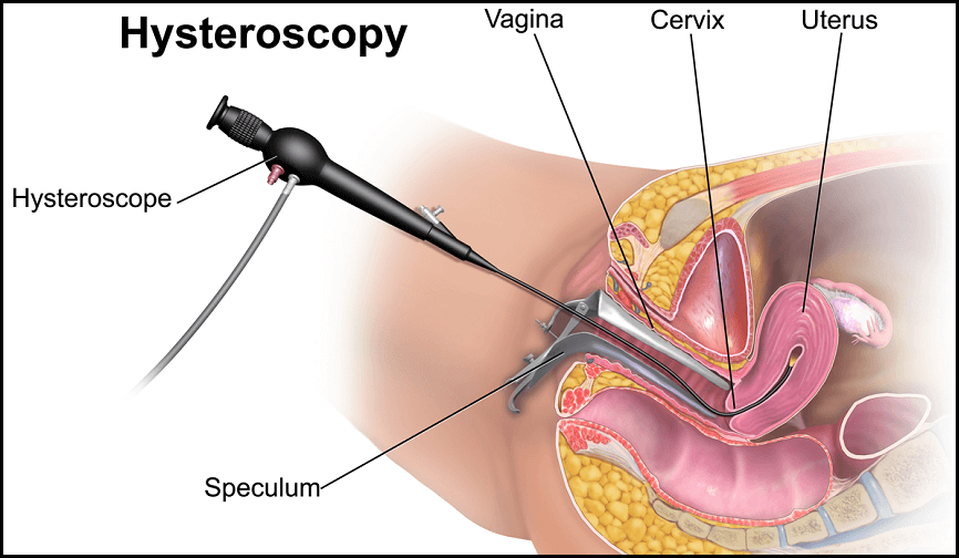 Laparoscopy